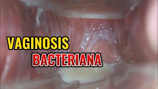 Vaginosis bacteriana  Dr Esteban Contreras [upl. by Fredkin]