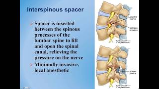 Lumbar Spinal Stenosis  Diagnosis and Treatment Options [upl. by Jenilee]