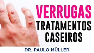 Tratamentos Caseiros para Verrugas – Dr Paulo Müller Dermatologista [upl. by Gati232]