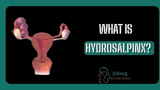 WHAT IS HYDROSALPINX [upl. by Leesen]