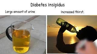 Diabetes insipidus Symptoms causes and treatment Diabetes insipidus vs diabetes mellitus [upl. by Ashly]