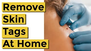 How to Quickly and Easily Remove Skin Tags at Home Using Things You Already Own [upl. by Eleinad]