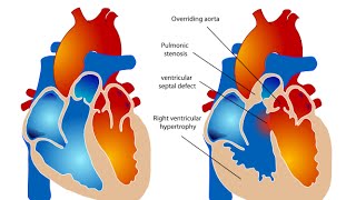 Tetralogy of Fallot [upl. by Stig]