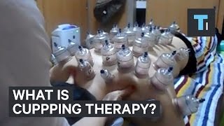 What is cupping therapy [upl. by Sellma]