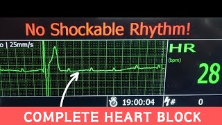 Third Degree AV Block  Complete Heart Block on Hospital Monitor cardiology [upl. by Giusto379]