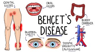 Behcets Disease  Signs and Symptoms with Triad  Pathophysiology  Criteria amp Treatment [upl. by Nraa824]