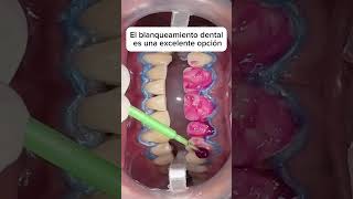 Mira lo que un blanqueamiento dental puede hacer por ti 🦷 [upl. by Axia]