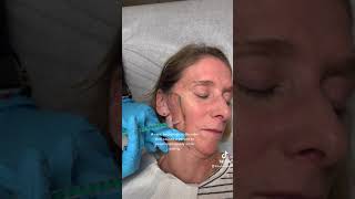 Botox Treatment for Freys syndrome [upl. by Brant699]