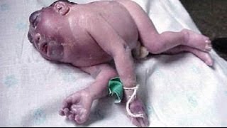 BABIES with BIRTH DEFECTS eg SMALL BRAINS due to RADIATION Research  2017 [upl. by Udall719]