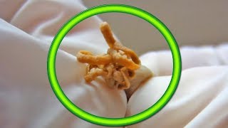 Dog Cysts Biggest Cyst on Pets Educational [upl. by Rratsal]