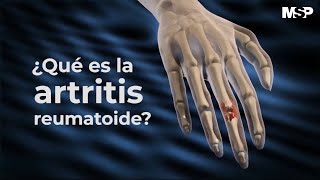 Artritis Reumatoide  ExclusivoMSP [upl. by Rawdan422]