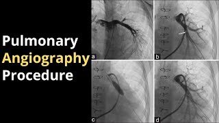 Pulmonary Angiography Procedure Angiogram Balloon Video [upl. by Furtek]