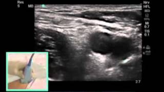 How To FEMORAL NERVE BLOCK  Dr Auyong Scanning Technique Video [upl. by Sabra]