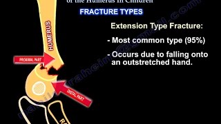 Supracondylar Fractures Of The Humerus In Children [upl. by Erdman636]