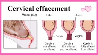 cervical effacement [upl. by Geminius]