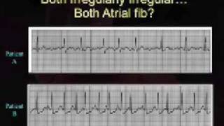 Intro EKG Interpretation Part 3 [upl. by Arnst]