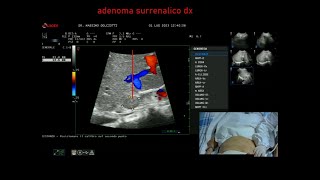 adenoma surrenalico destro ed ascite [upl. by Samella]