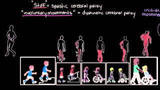 Dyskinetic cerebral palsy case 2 [upl. by Dorene761]