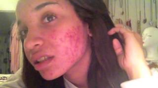 My Acne Journey 201213 Severe Cystic Acne  RAVEN ELYSE [upl. by Jaymee]