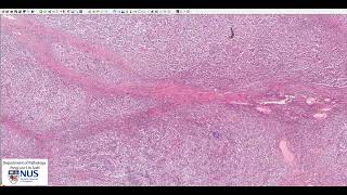 Testis Seminoma  Microscopy Talking slide [upl. by Stalk405]