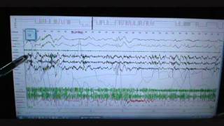 Sleep Study Scoring on Person with Severe Sleep Apnea and snoring Polysomnograph [upl. by Aihsenor]