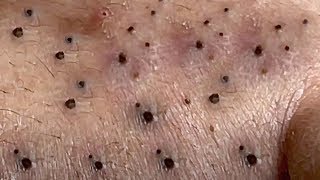 Blackheads Removal Big Acne blackheads Extraction Whiteheads [upl. by Rakia]