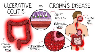 Inflammatory Bowel Disease  Ulcerative Colitis v Crohns Disease With Histology amp Manifestations [upl. by Bronson345]