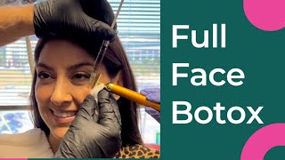 The Full Face Botox TreatmentThe RJR Method [upl. by Brenn]