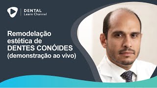 Remodelação estética de dentes conóides demonstração ao vivo [upl. by Fuller655]