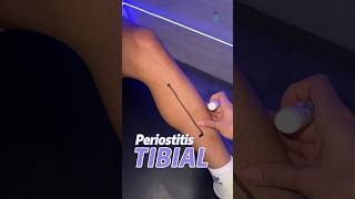 ¿Qué es la periostitis tibial fisioterapia lesiones runner [upl. by Acired579]