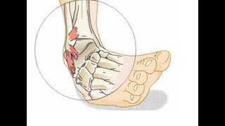 Lateral Ankle Sprain vs High Ankle Sprain Whats the Difference [upl. by Dumah]