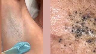 Ingrown hair  Ingrown hair removal  Pimple popping [upl. by Cannon]