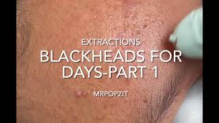 Blackheads for days part 1 12 minutes of just the popacne extractions Pimple poppingwaxy plugs [upl. by Misti]