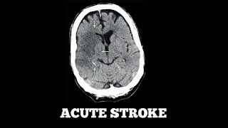 Acute Stroke Case Discussion [upl. by Ecertal]