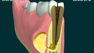 Ascesso la terapia endodontica [upl. by Punke]