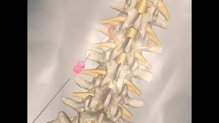 What is lumbar facet Radiofrequency ablation Treatment for lower back pain [upl. by Eugine]