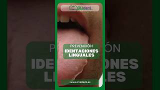 Identaciones linguales clinicadental posturologia [upl. by Nahallac]