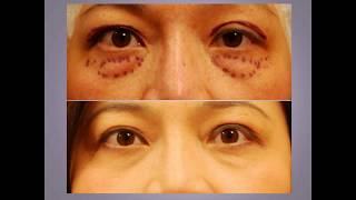 ChaseLayMD Ptosis Droopy Eyelid Surgery [upl. by Yadroc859]