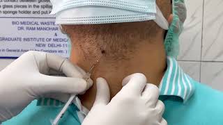 Immunotherapy in warts  Injection MMR for the treatment of warts  Dr Bhawuk Dhir [upl. by Innattirb]