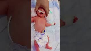 RDS newbornbaby medicallife newbornbabycare youtubeshorts nicu viral [upl. by Sidell972]