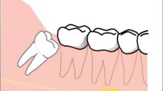 alte Version Erklärung spezieller Probleme und Risiken bei der Weisheitszahnentfernung [upl. by Minni699]