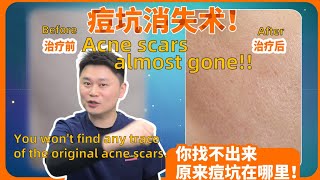 痘坑消失术真的存在！How I remove acne scars in four treatments [upl. by Odnalref]