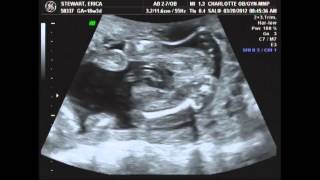 Live Ultrasound at 18 weeks 3 days pregnant with baby number two [upl. by Nie503]