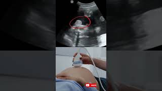 🤰💕 Ultrasound image showing baby boy with chord around his neck 🤰 Ultrasound case baby newborn [upl. by Jerrold]