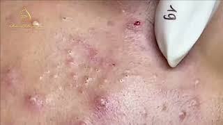 Loan Nguyen Acne Treatment 1737h [upl. by Zanlog]