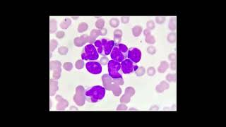 Acute Myeloid Leukemia AML Symptoms and Causes  Diagnosis  Treatment  Prevention health [upl. by Alrrats]