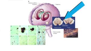 Curing Parkinsons by transplanting cells [upl. by Retsub]