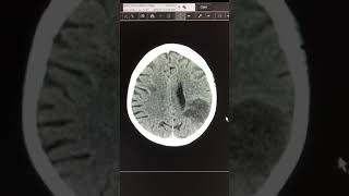 Acute cardioembolic stroke [upl. by Bridwell935]