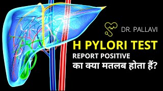 H Pylori Positive Report Meaning and Symptoms  Helicobacter Pylori Test Report Explained [upl. by Eiroj]