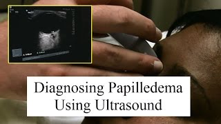 Using Ultrasound to Diagnose Papilledema [upl. by Emmey]